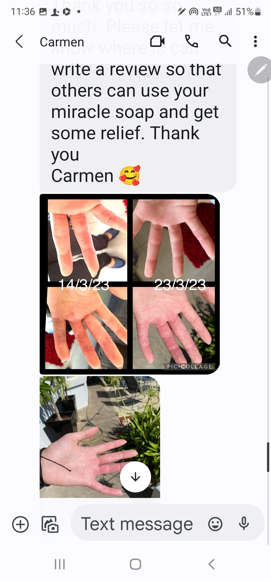 ECZEMA