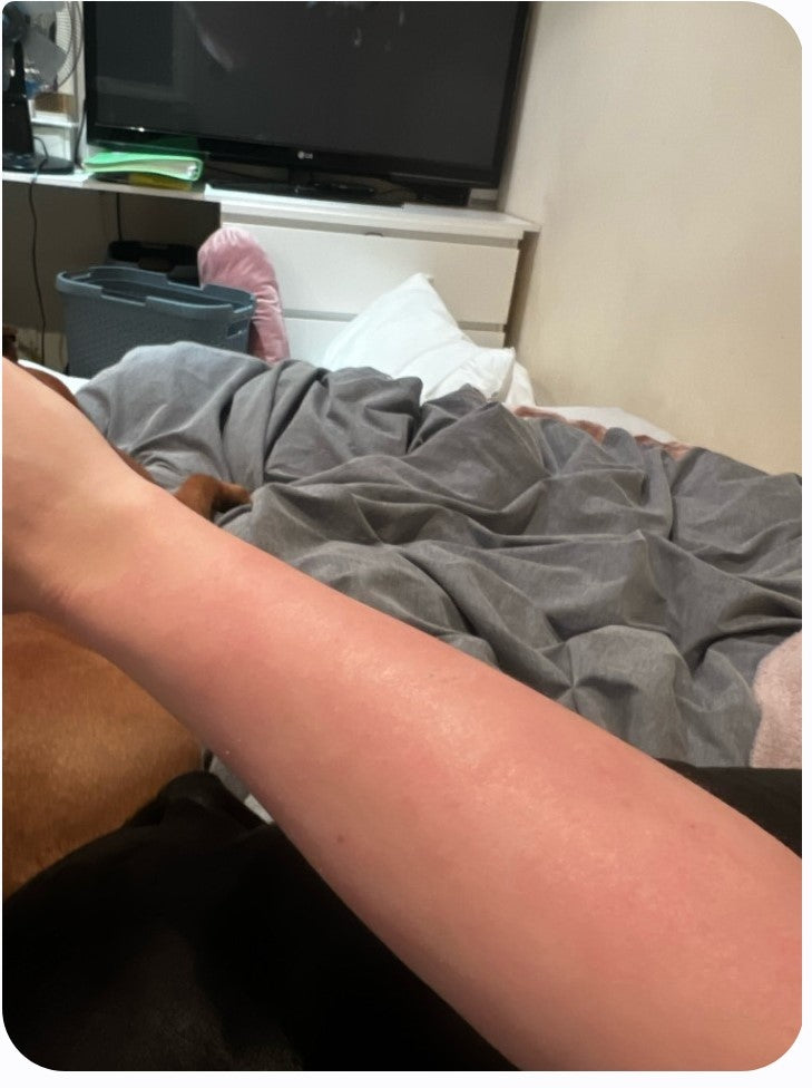 ECZEMA