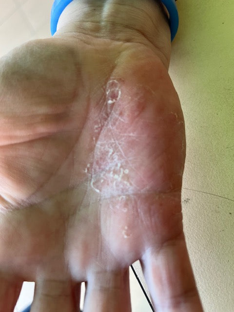 ECZEMA