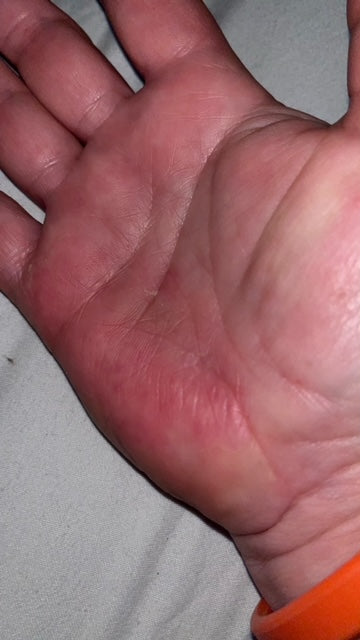 ECZEMA