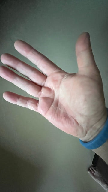 ECZEMA