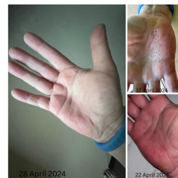 ECZEMA