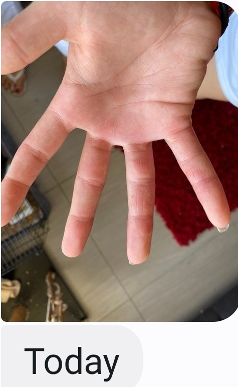 ECZEMA